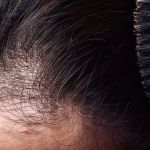 Patterned Hair Loss in Women