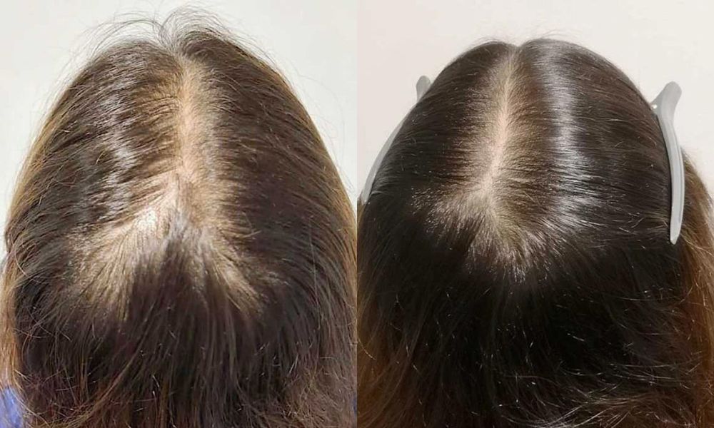 V HAIR BEFORE AFTER 1