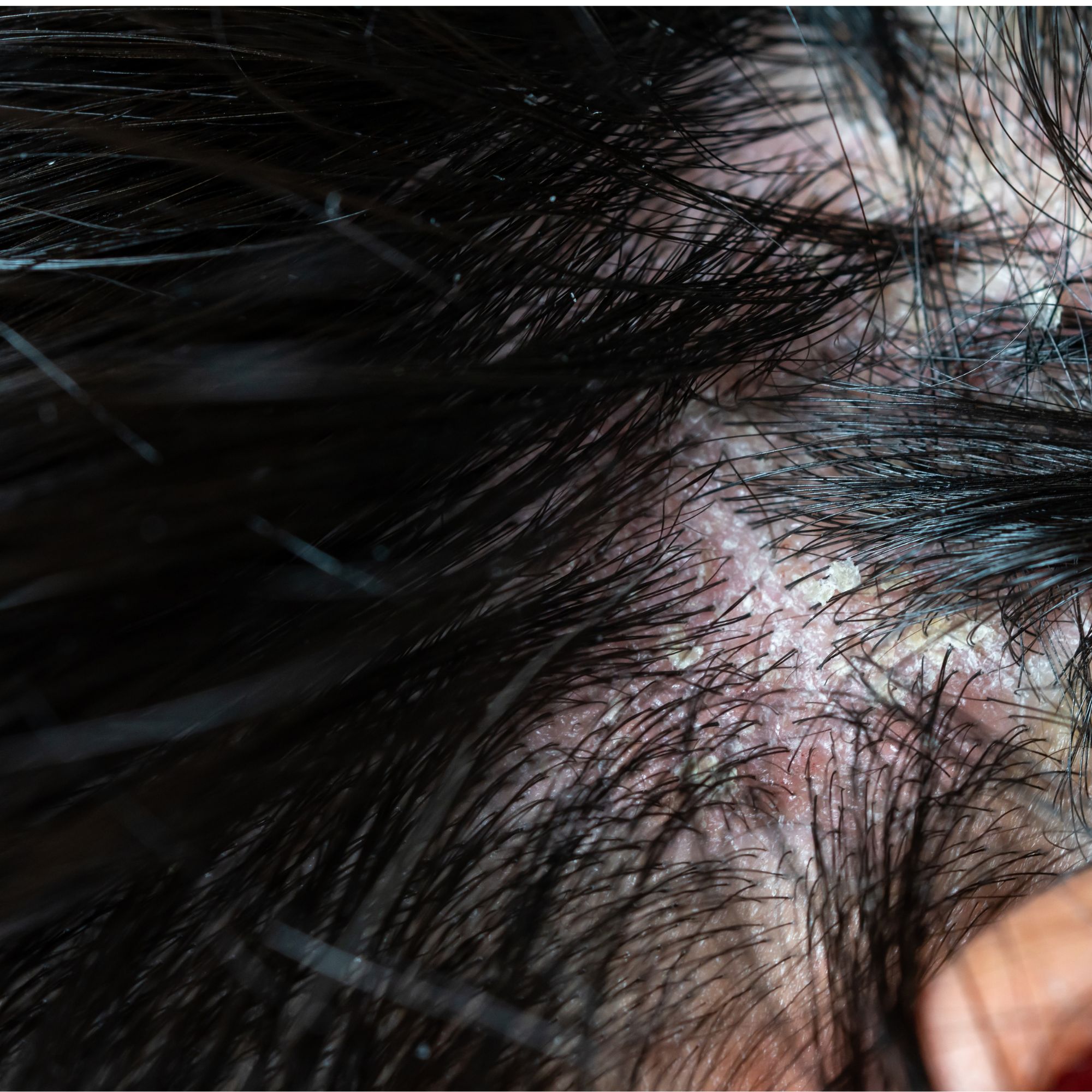 Blocked Hair Follicles