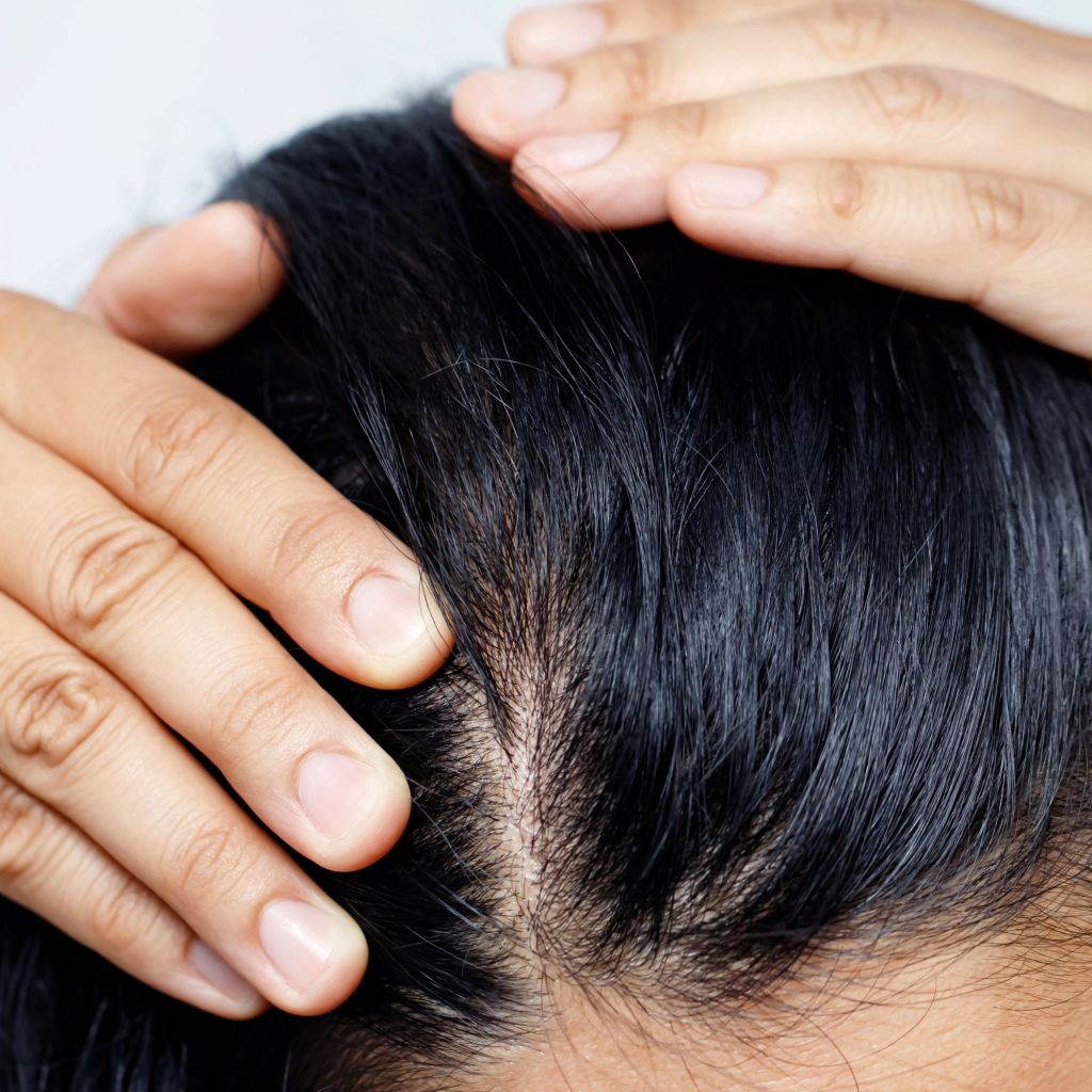 Oily Scalp