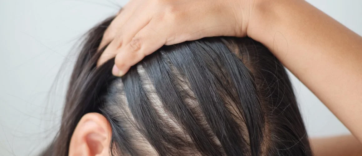 Thinning Hair in Your 20s or 30s? What to Do Now