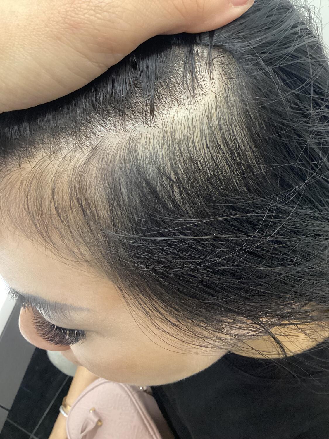Patterned Hair Loss