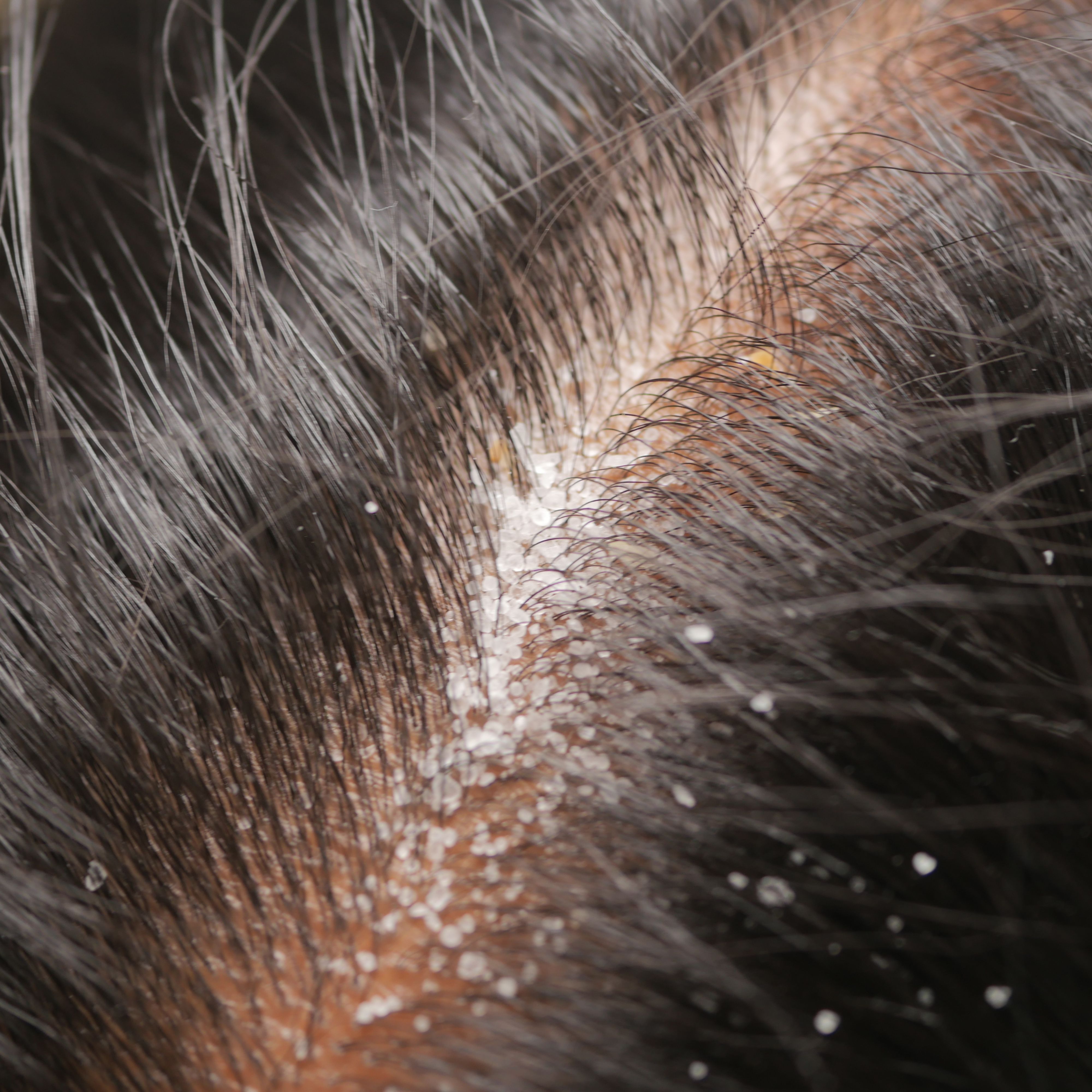 clogged scalp