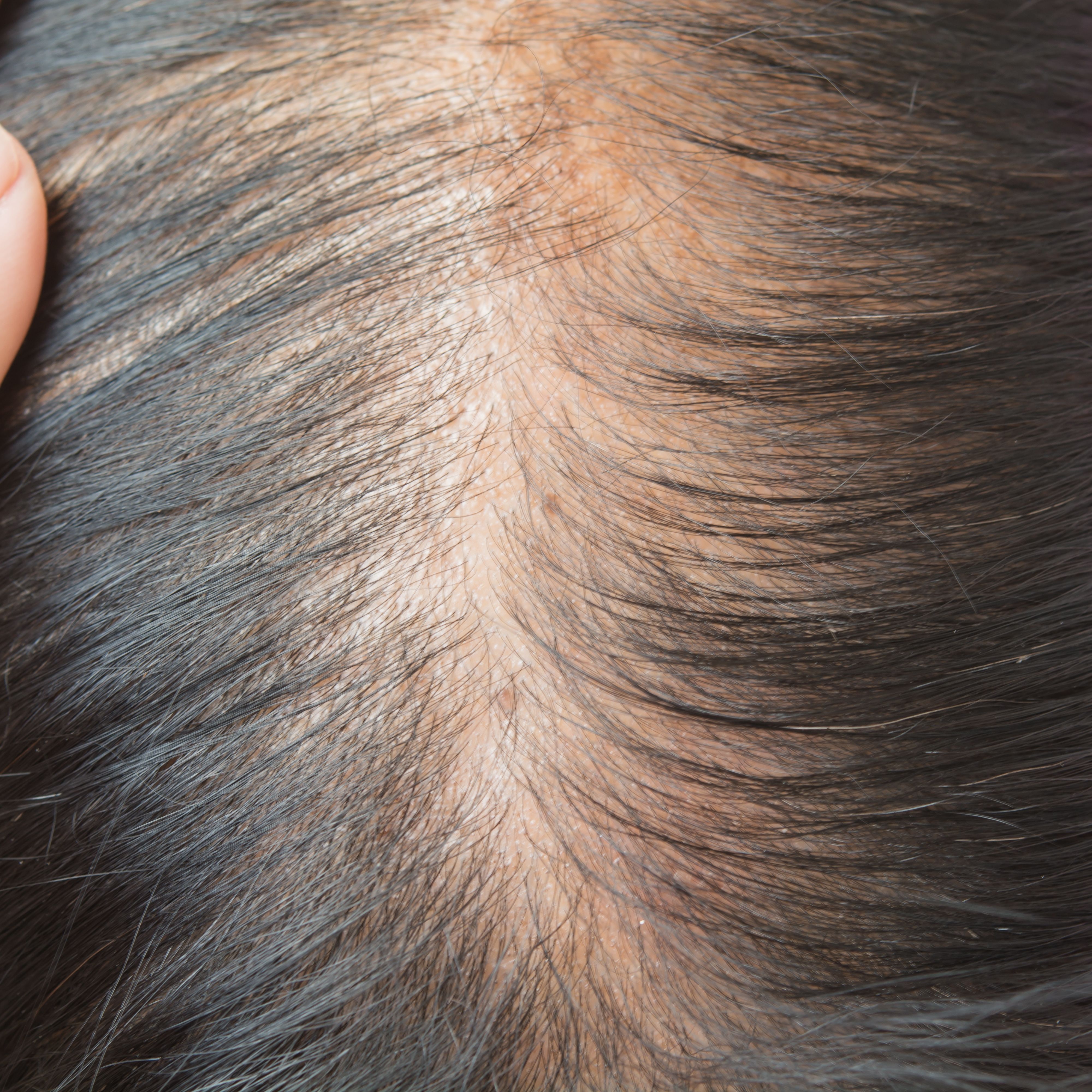 thin hair