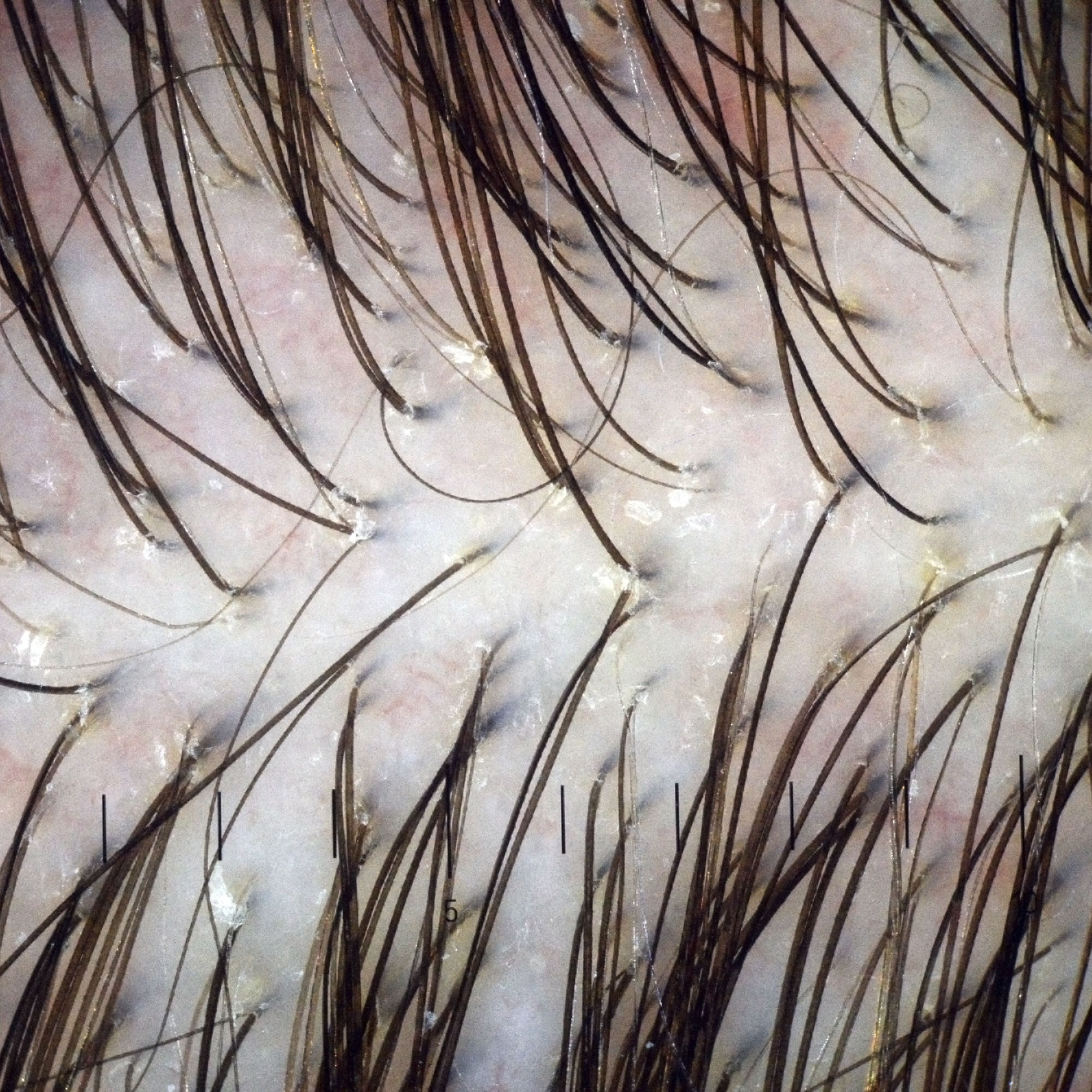 oily scalp