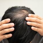 blocked hair follicles