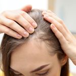 hair thinning
